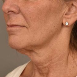Facelift Before & After Patient #1359