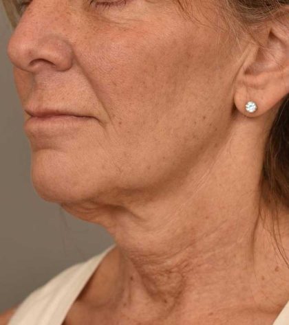 Facelift Before & After Patient #1359