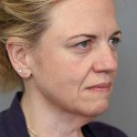 Facelift Before & After Patient #1371