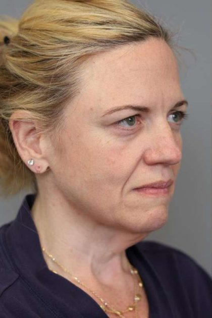 Facelift Before & After Patient #1371