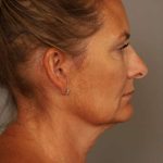 Facelift Before & After Patient #1380