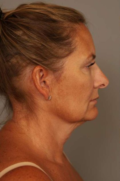 Facelift Before & After Patient #1380