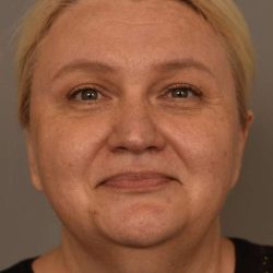 Facelift Before & After Patient #1389