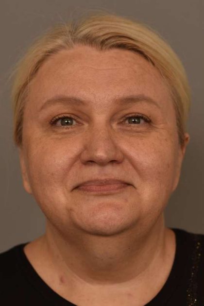 Facelift Before & After Patient #1389