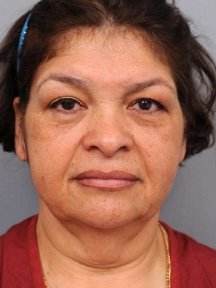Facelift Before & After Patient #1399