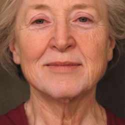 Facelift Before & After Patient #1404