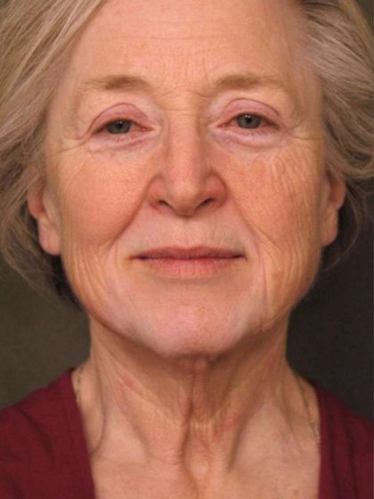 Facelift Before & After Patient #1404
