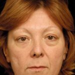 Facelift Before & After Patient #1411