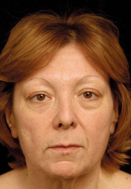 Facelift Before & After Patient #1411