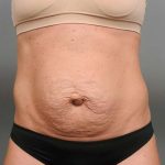 Tummy Tuck Before & After Patient #338