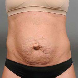 Tummy Tuck Before & After Patient #338