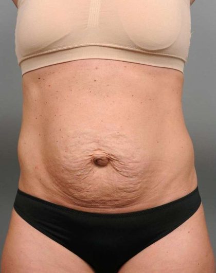 Tummy Tuck Before & After Patient #338