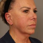 Facelift Before & After Patient #1418