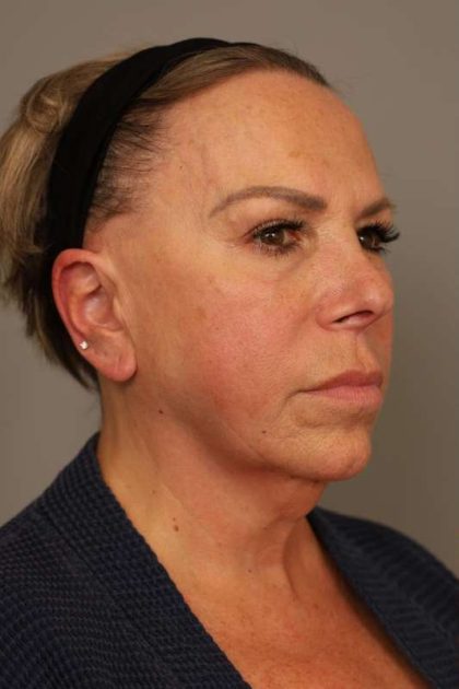 Facelift Before & After Patient #1418