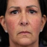 Facelift Before & After Patient #1427