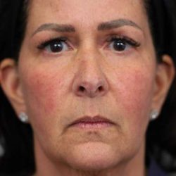 Facelift Before & After Patient #1427