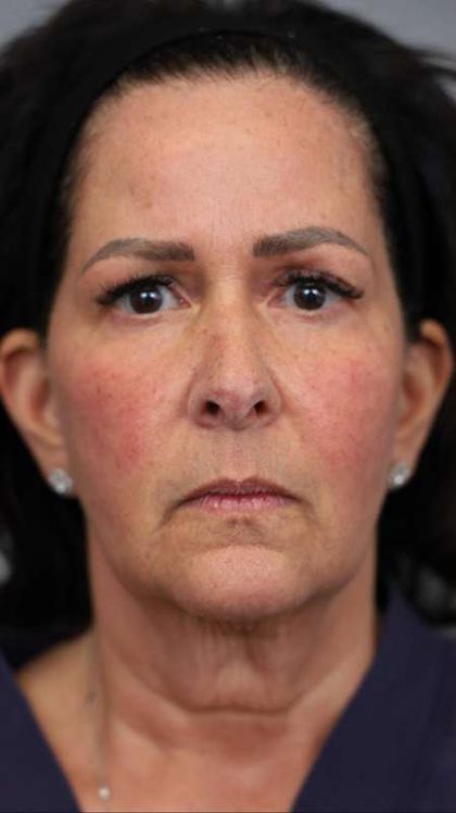 Facelift Before & After Patient #1427