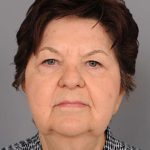 Facelift Before & After Patient #1436