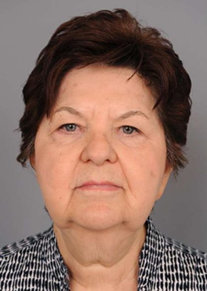 Facelift Before & After Patient #1436