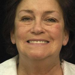 Facelift Before & After Patient #1443