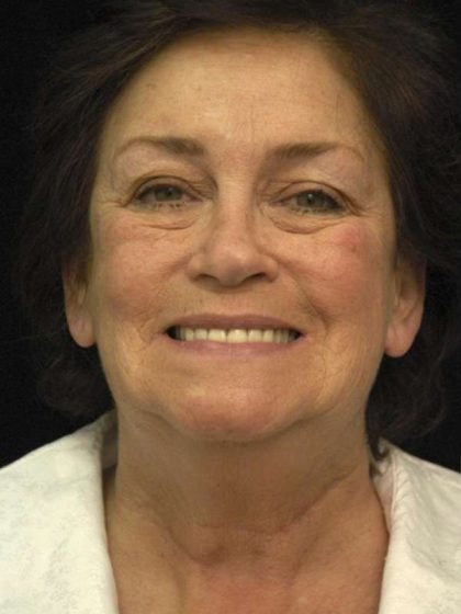 Facelift Before & After Patient #1443