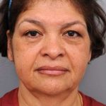 Naturalift&trade; Mini Facelift Before & After Patient #1452