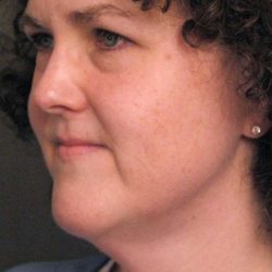 Naturalift™ Mini Facelift Before & After Patient #1457