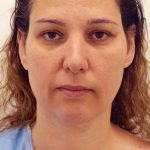 Naturalift&trade; Mini Facelift Before & After Patient #1464