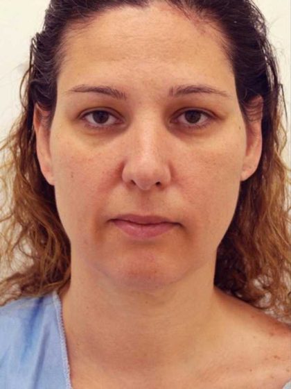 Naturalift™ Mini Facelift Before & After Patient #1464