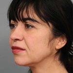 Naturalift&trade; Mini Facelift Before & After Patient #1474