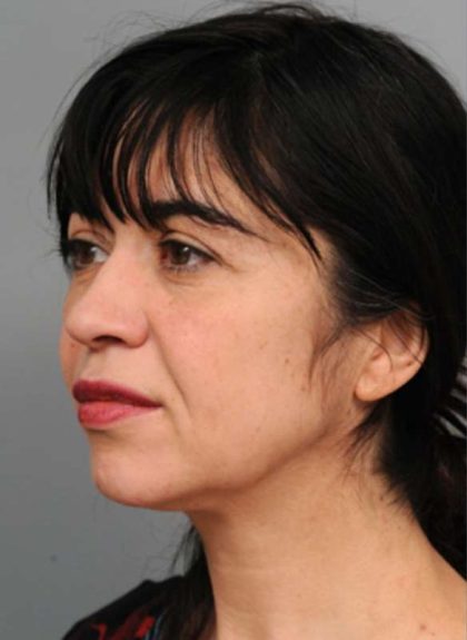 Naturalift™ Mini Facelift Before & After Patient #1474