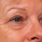 Eyelid Surgery Before & After Patient #1481