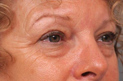 Eyelid Surgery Before & After Patient #1481