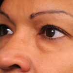 Eyelid Surgery Before & After Patient #1490