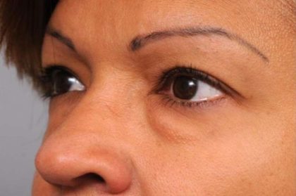 Eyelid Surgery Before & After Patient #1490