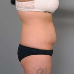 Tummy Tuck Before & After Patient #345