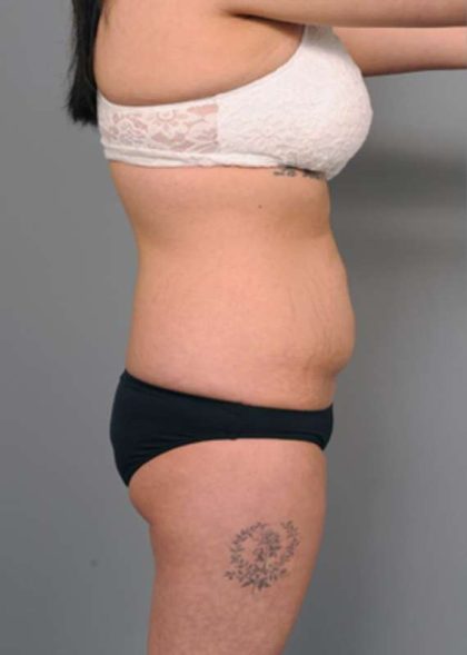 Tummy Tuck Before & After Patient #345