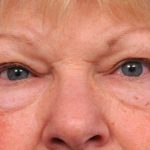 Eyelid Surgery Before & After Patient #1504