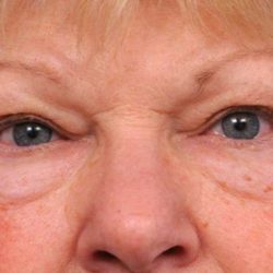 Eyelid Surgery Before & After Patient #1504