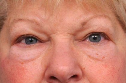 Eyelid Surgery Before & After Patient #1504