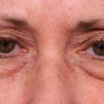 Eyelid Surgery Before & After Patient #1509