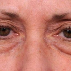 Eyelid Surgery Before & After Patient #1509
