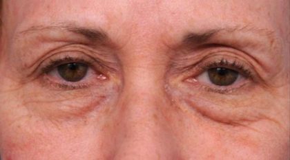 Eyelid Surgery Before & After Patient #1509