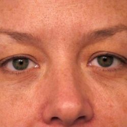 Eyelid Surgery Before & After Patient #1514