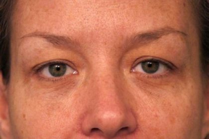 Eyelid Surgery Before & After Patient #1514