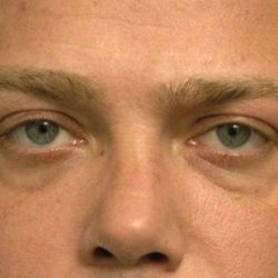 Eyelid Surgery Before & After Patient #1519