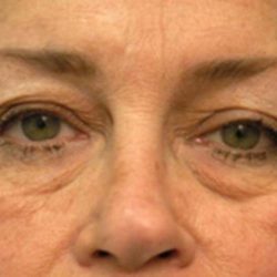 Eyelid Surgery Before & After Patient #1525