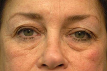Eyelid Surgery Before & After Patient #1525