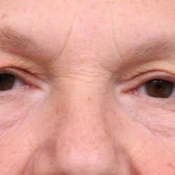 Eyelid Surgery Before & After Patient #1530