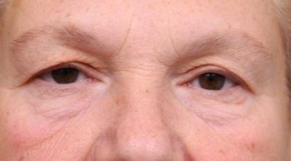Eyelid Surgery Before & After Patient #1530